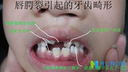 唇腭裂引起的牙齿问题有哪些