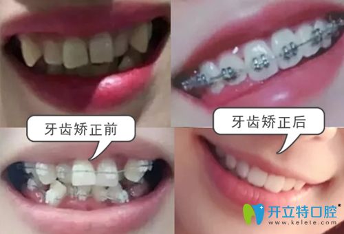 珠海九龙口腔牙齿矫正前后效果对比图 珠海九龙口腔牙齿矫正前后效果对比图