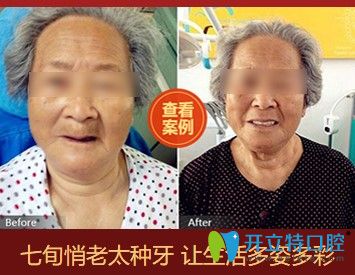 天津中诺口腔立得用种植牙案例图