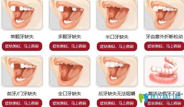 哪些牙齿症状需要做种植