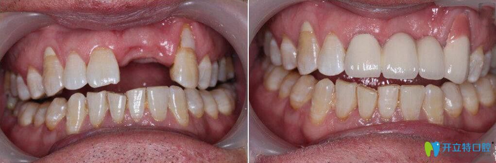 银座牙客口腔前牙美学种植案例前后效果对比图