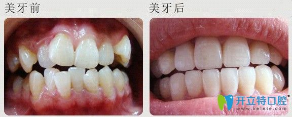 广州壹加壹口腔牙齿不齐矫正案例 广州壹加壹口腔牙齿不齐矫正案例