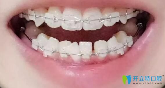 我牙齿拥挤在杭州雅舒口腔做矫正4个月