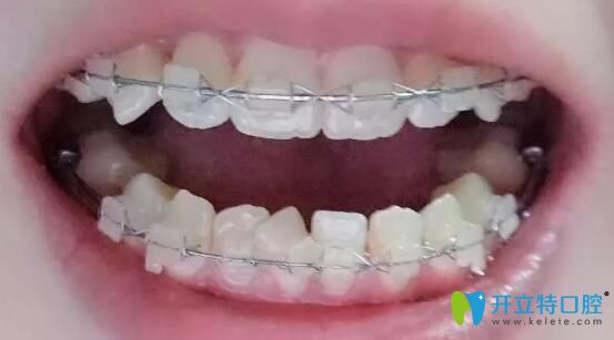 我在杭州雅舒口腔做牙齿矫正6个月