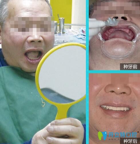 维乐口腔56岁余先生全口牙即刻负重种植案例