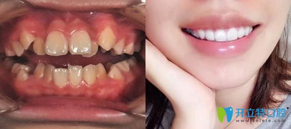 常州北极星口腔牙齿矫正案例效果