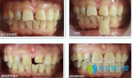瑾帆口腔牙齿瓷贴面修复案例 瑾帆口腔牙齿瓷贴面修复案例