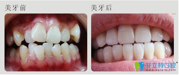 成都圣贝口腔牙齿不齐矫正案例 成都圣贝口腔牙齿不齐矫正案例