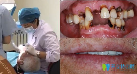 70岁老人在佛山春芽口腔做11颗种植牙前后效果对比图