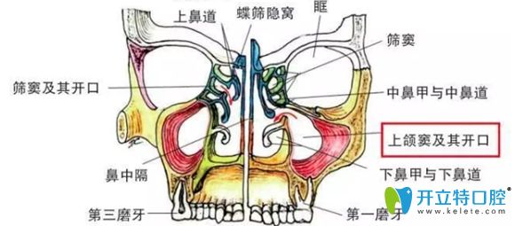 什么是上颌窦提升术