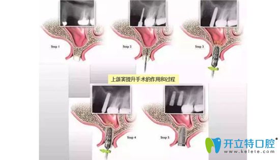 上颌窦外提升和内提升的区别
