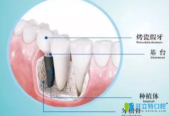 维乐口腔种植牙是由基台、种植体组成图示