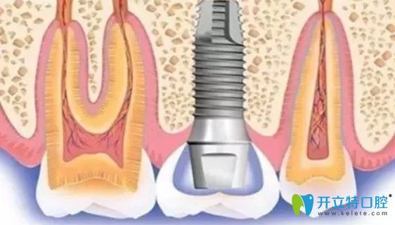 北京维乐口腔种植体图示