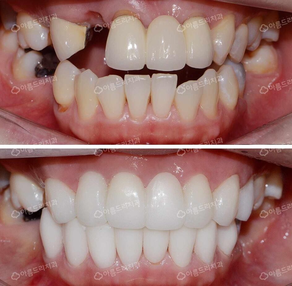 查看大图瓷贴面修复牙齿案例查看大图种植牙前后对比案例医院简介医生