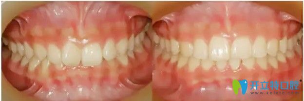 广大口腔牙齿深覆颌矫正案例