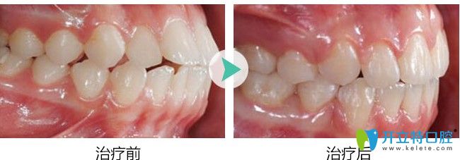 广大口腔龅牙矫正案例