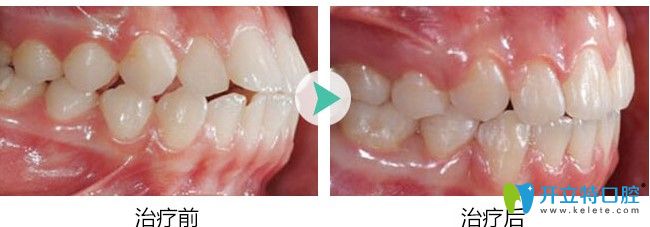 广大口腔龅牙矫正 广大口腔龅牙矫正