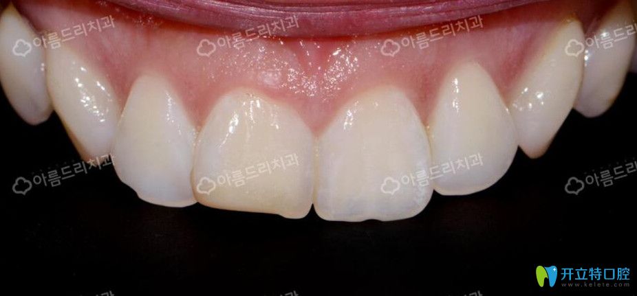 韩国安特丽做牙贴面前牙齿情况