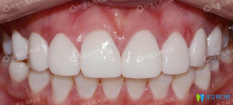韩国安特丽做牙齿矫正后照片