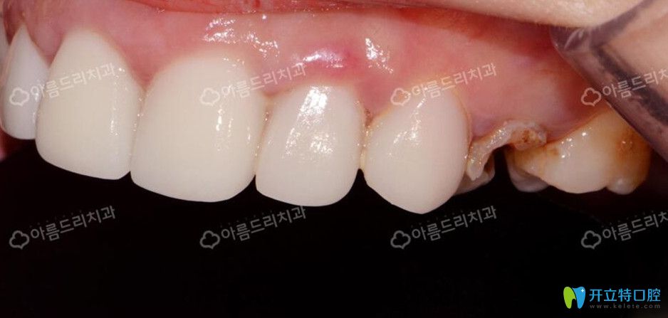 去韩国安特丽做后牙种植前