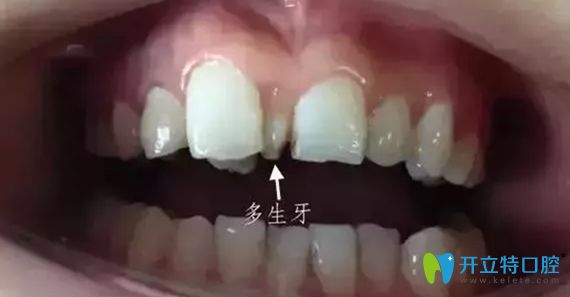 埋伏牙与多生牙区别图 埋伏牙与多生牙区别图