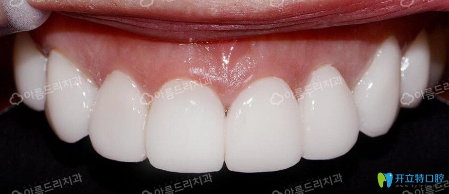韩国安特丽牙贴面后效果图