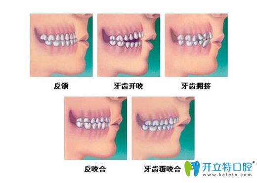 宁波恒美口腔顾俞凯医生介绍牙齿矫正的年龄