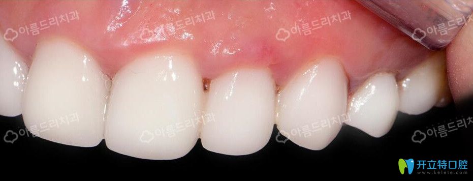 韩国安特丽后牙种植后效果图展示