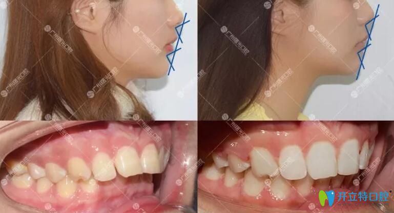 广州曙光医院员工矫正牙齿案例