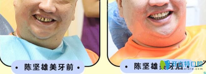 陈先生采用瓷贴面修复发黄牙齿案例