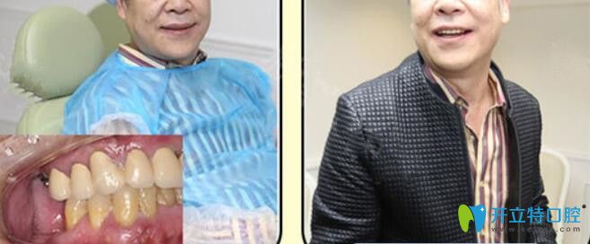 二级演员苏先生在广州柏德口腔种植牙案例