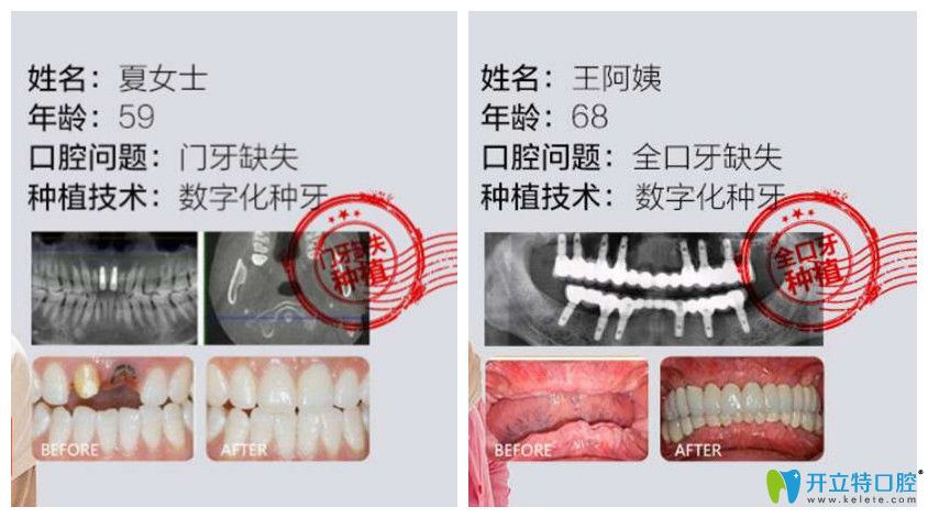 德韩口腔门牙种植+全口牙缺失种植案例效果对比