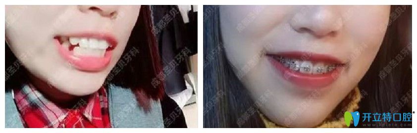 圣贝口腔龅牙矫正案例图示 圣贝口腔龅牙矫正案例图示