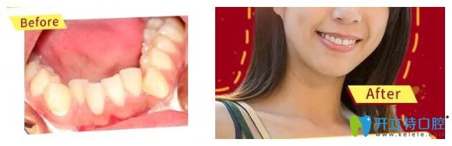 22岁经理助理在柏德口腔矫正牙齿案例