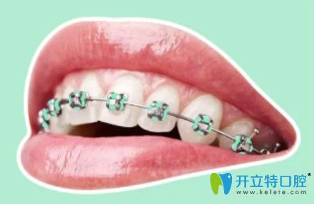 圣贝口腔炫彩金属牙套 圣贝口腔炫彩金属牙套