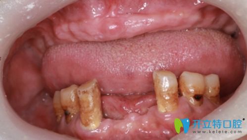 上海杨浦区美呀植联口腔的allon6上半口种植牙病例展示