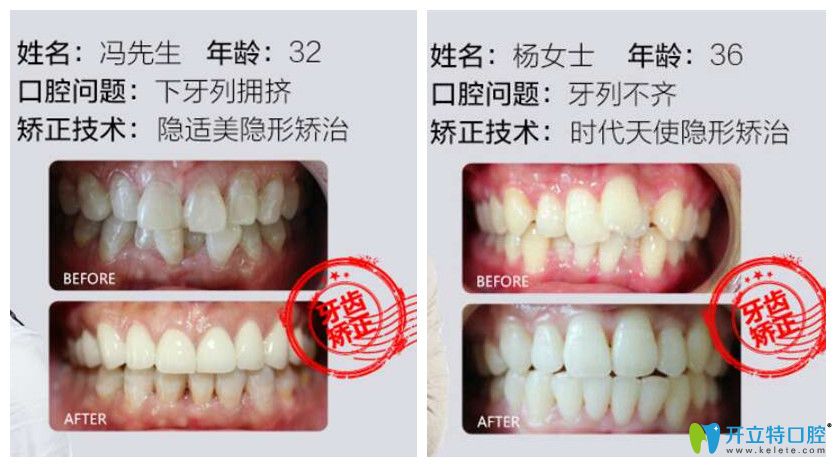 德韩口腔牙齿矫正案例前后效果对比图 德韩口腔牙齿矫正案例前后效果对比图