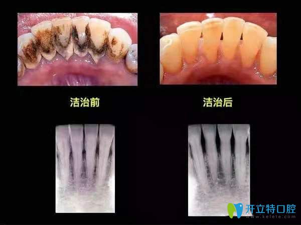 360度超声波深层洁牙前后对比图