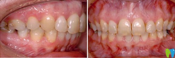 西安中诺口腔突嘴龅牙齿矫正术后效果图