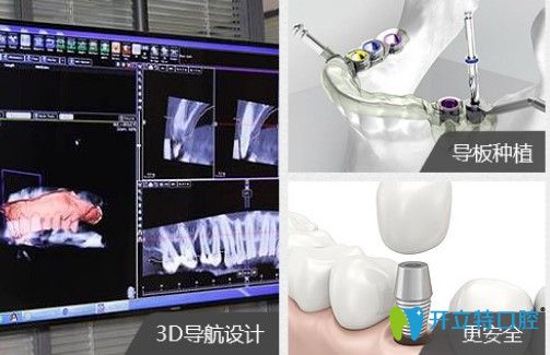 维恩口腔即种即用技术图示