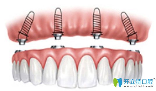 维恩口腔ALL-on-4种植技术