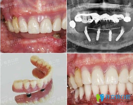 维恩口腔全口种牙案例图