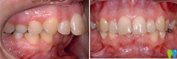 西安中诺口腔龅牙突嘴矫正术前照