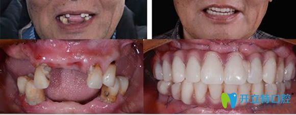 西安中诺口腔全口牙种植前后效果对比图