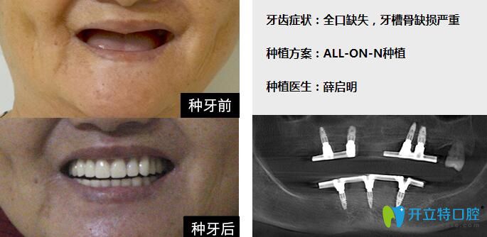 广州柏德口腔牙医薛启明全口种植牙案例