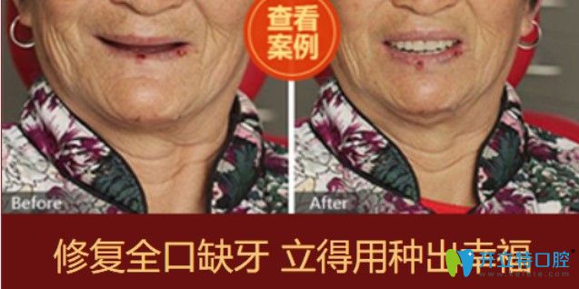 中诺口腔全口牙缺失种牙案例图