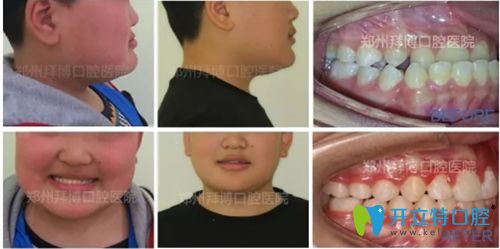 郑州拜博口腔青少年牙齿正畸前后对比图