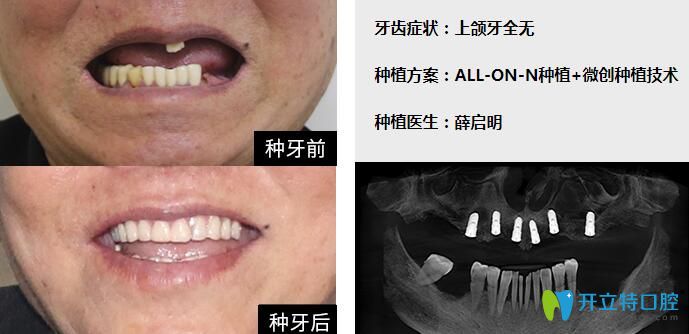 广州柏德口腔薛启明医生半口种植牙案例