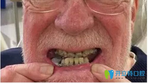 美国75岁高龄老人还做牙齿矫正