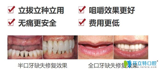 中诺口腔立得用种植牙优势